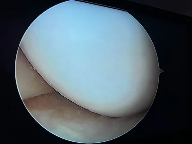 Cartilage normal, lisse et nacré (arthroscopie)