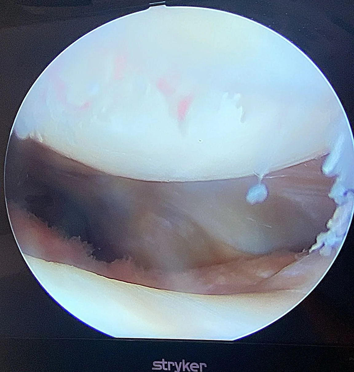Cartilage rotulien normal
