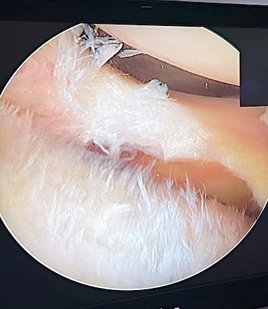 Fibro-cartilage de réparation après micro-perforations