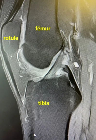 IRM du genou montrant le fémur, le tibia et la rotule