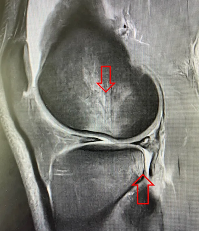 IRM montrant une contusion osseuse lors d'une rupture du LCA (choc des surfaces osseuses)