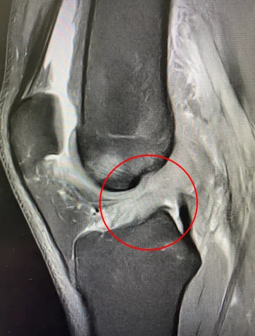 IRM : rupture du ligament croisé antérieur