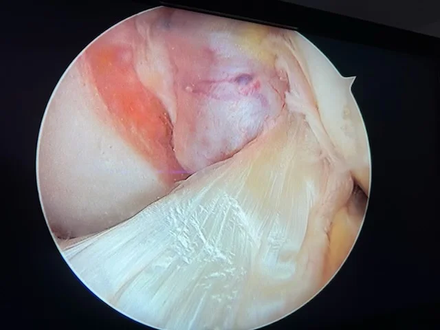 LCA normal vu en arthroscopie
