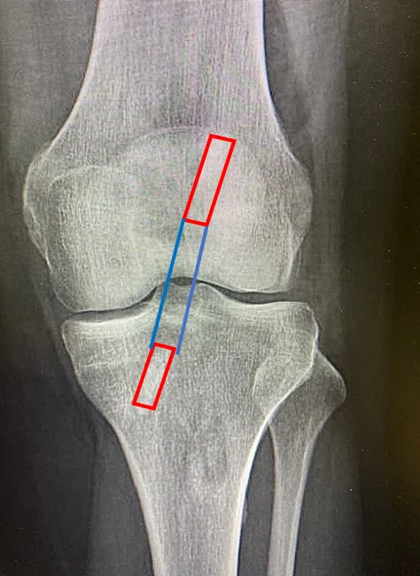 Ligamentoplastie Kenneth Jones — radiographie de face