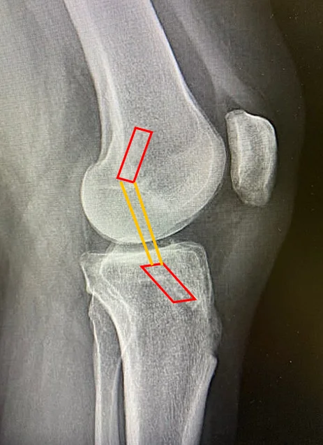 Ligamentoplastie Kenneth Jones — radiographie de profil post-opératoire
