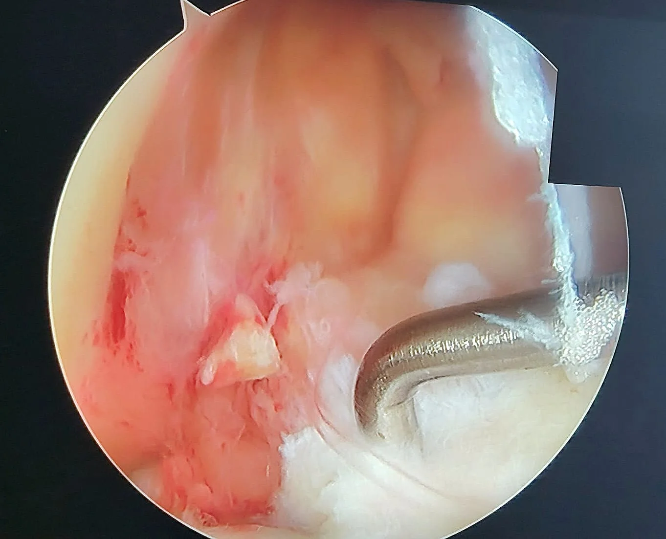 Moignon du LCA rompu (arthroscopie)
