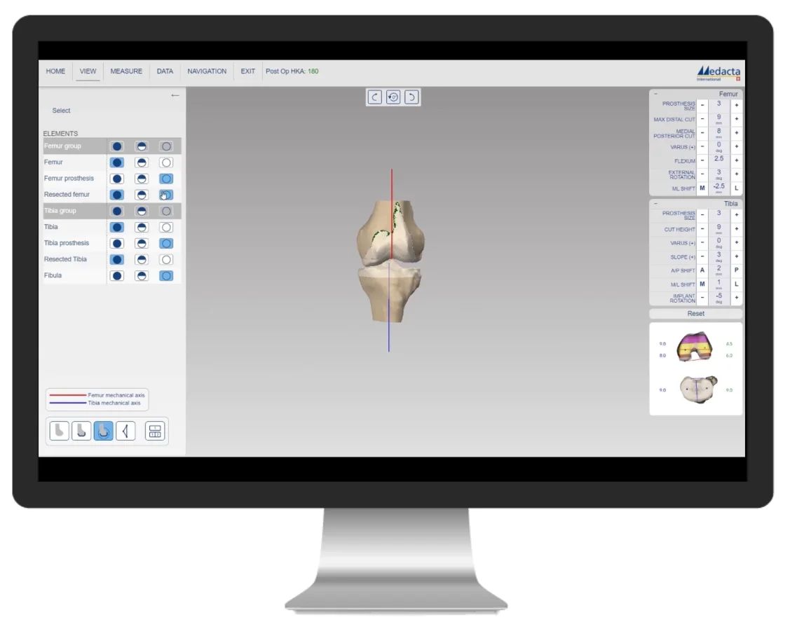 Planification scanner de la prothèse totale de genou