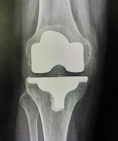 Radiographie d'une prothèse totale de genou